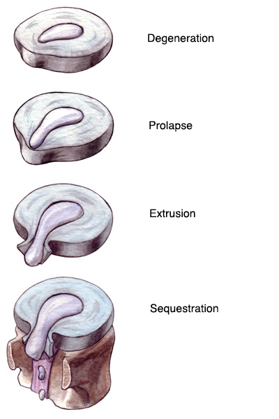 Disc Degeneration