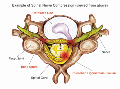 Nerve Compression